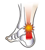 achilles tendonitis