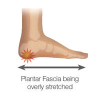 Calcaneal Spur