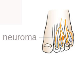 morton's neuroma treatment