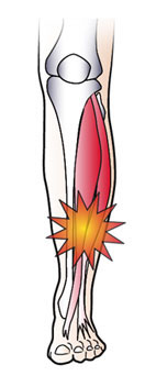 shin splints and shin pain