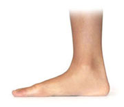 flat feet